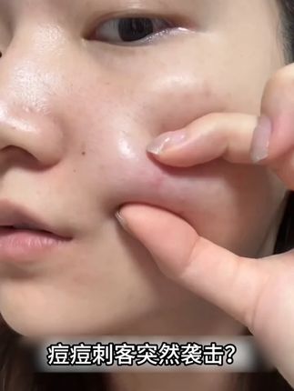 透明痘痘贴