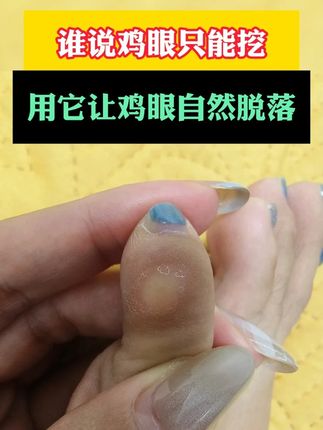 脚底板上的鸡眼不要再用刀去挖了!教你一个安全有效的方法! #鸡眼 脚底板上的鸡眼不要再用刀去挖了!教你一个安全有效的方法!#鸡眼去除小妙招 #脚上有老茧走路疼怎么办 #草本 #鸡眼跖疣