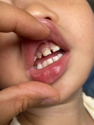 孩子牙齿发出的信号一定不能忽视#禾贝儿童牙膏