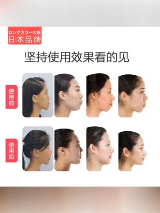儿童唇肌训练器张嘴睡觉纠正口呼吸腺样体肥大面容矫正器闭嘴神器 #必备 #日用品
