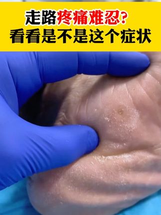 长了鸡眼,走路特别的疼!这样处理! #鸡眼 长了鸡眼,走路特别的疼!这样处理!#鸡眼去除小妙招 #鸡眼跖疣 #草本 #中老年
