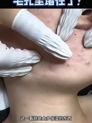 姿珂莱小黄瓶祛痘精华乳舒缓祛痘改善泛红深沉修缓痘损肌肤