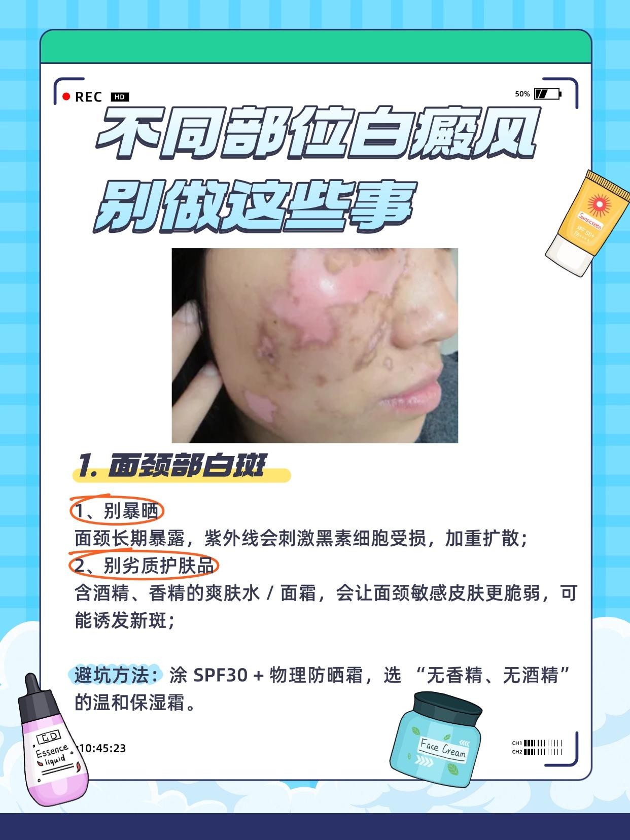 不同部位白癜风别做这些事。#308光疗仪#希格玛308光疗仪#白癜风#白斑