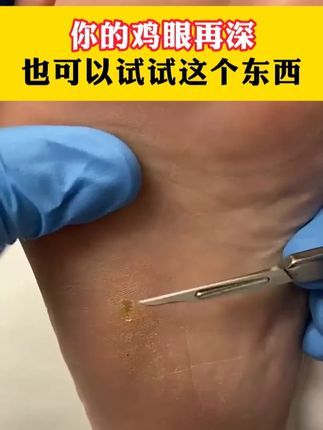 鸡眼别乱治,小心越来越严重!试试这个方法! #鸡眼 别乱治,小心越来越严重!试试这个方法!#鸡眼去除小妙招 #鸡眼跖疣 #老茧 #脚上有老茧走路疼怎么办