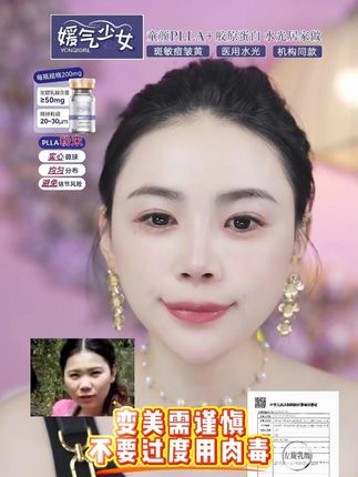 变美需谨慎,肉毒不要多用 #媛气少女YONQIGIRL #媛气少女童颜PLLA #媛气少女胶原蛋白 #媛气少女居家水光 #三型胶原蛋白