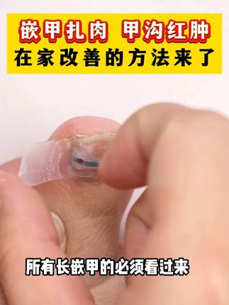 指甲扎肉是嵌甲,一个方法在家处理#甲沟炎#嵌甲#甲沟炎红肿疼怎么处理