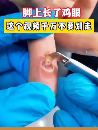 #鸡眼 #鸡眼去除小妙招 #鸡眼怎么能彻底根治 #疣怎么去除