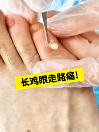 长鸡眼走路痛!用它就对了#鸡眼 #鸡眼跖疣 #鸡眼去除小妙招 #老茧 #老茧怎么去除