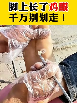 长了鸡眼,走路特别的疼!这样处理! #鸡眼 长了鸡眼,走路特别的疼!这样处理!#鸡眼去除小妙招 #老茧 #脚上有老茧走路疼怎么办 #中老年