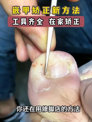 嵌甲就用正甲贴,在家处理不花冤枉钱#嵌甲#甲沟炎#国货