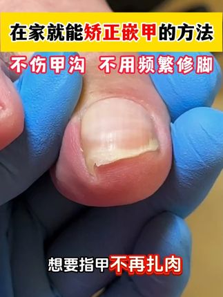嵌甲就用正甲贴,在家处理不花冤枉钱#嵌甲#甲沟炎#国货