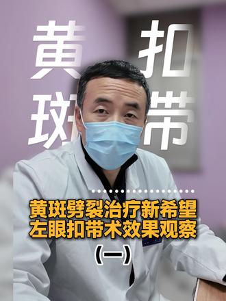 黄斑劈裂治疗新希望:左眼扣带术效果观察(一) 主要用来治疗高度近视引起的一种复杂眼底病变——黄斑劈裂、黄斑裂孔或因此引发的视网膜脱离,尤其是当患者眼球后极部存在 “后巩膜葡萄肿” 时。把它理解为一种在眼球壁上进行的“支撑”或“复位”手术。#黄斑扣带 #高度近视 #后巩膜加固术 #抖音知识年度大赏 #健康科普