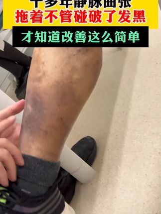 十多年静脉曲张,拖着不管碰破了发黑,才知道改善这么简单 #静脉曲张 #静脉曲张微创 #静脉曲张怎么办 #静脉曲张手术 #静脉曲张老烂腿