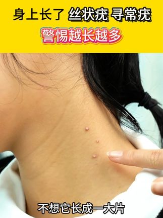 脖子上有了小肉丁,肉刺疙瘩别烦恼! #变好看 #热点 #脖子上长的小肉粒是什么 #手上长了个大包 #丝状疣是怎么引起的