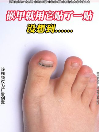 嵌甲甲沟炎一定要重视起来 这个办法轻松改善 #ZRL#脚指甲往肉里长怎么办#嵌甲#甲沟炎#甲沟炎红肿疼怎么处理