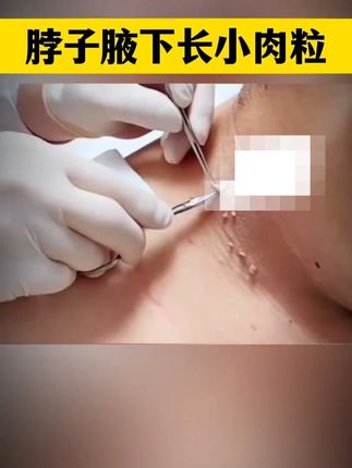 #私密护理天花板 #皮肤管理 #皮肤护理 #小肉条护理膏 #小肉粒护理膏
