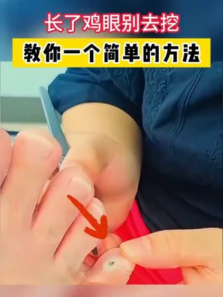 长了鸡眼别去挖,教你一个简单的方法,来试试这个 #鸡眼 #鸡眼跖疣 #鸡眼去除小妙招 #老茧 #脚