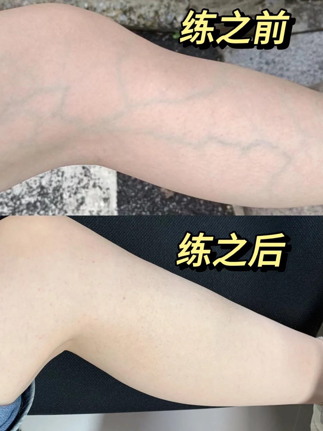静脉曲张的家人们都去练!!!。每天跟着p2练习30分钟左右,拉伸动作做到位,日常搭配静脉曲张袜,青筋远离退。坚持一段时间,你会来感谢我的! #静脉曲张 #腿部训练 #弹力袜 #打卡 #李护士静脉曲张袜