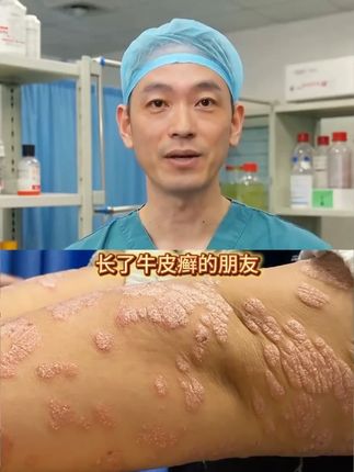身上有癣瘙痒难忍就去用用看#牛皮癣#股癣#体癣#手足癣#皮炎