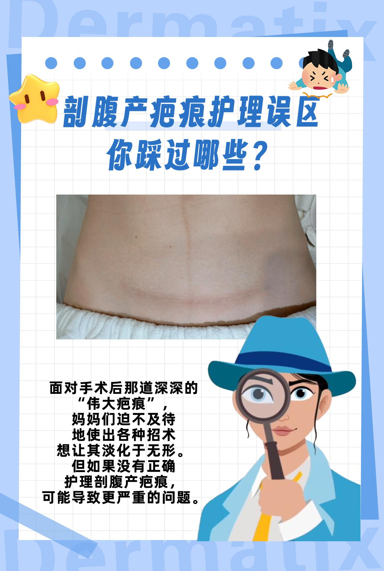 剖腹产疤痕误区,你踩过哪些?。#酯化VC#淡化疤痕#剖腹产疤痕#妈妈必看#手术疤痕