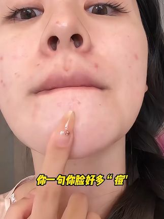 姿珂莱小黄瓶祛痘精华乳舒缓祛痘改善泛红深沉修缓痘损肌肤