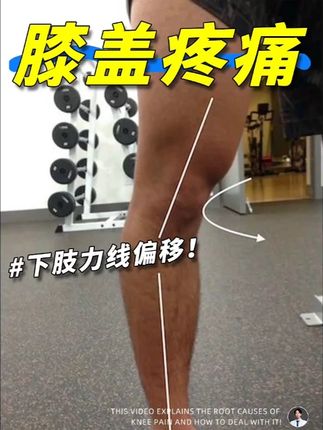 膝盖疼痛不适,根源在于下肢力线偏移 #抖出健康知识宝藏 #健康乘风计划 #跟着专业派练出好状态 #运动康复 #膝盖保护