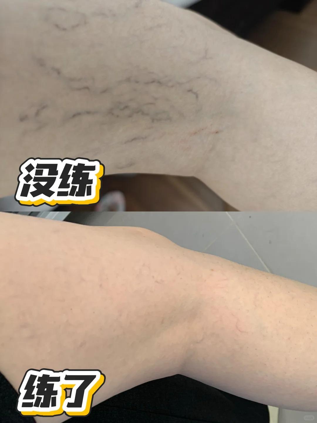 成功和静脉曲张说拜拜。每天跟着p2拉伸腿部 日常坚持穿静脉曲张袜 #静脉曲张弹力袜 #腿部瑜伽 #打卡 #静脉曲张