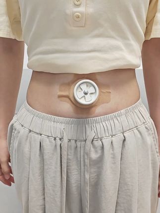 连灸半个月,确实有变化 晚上吃一个🍎都下不去❓考虑下是不是中焦不通,用随身灸筒解放双手#艾灸 #隔姜灸 #三伏艾灸