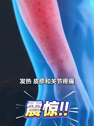 最近谁还不知道要预防蚊子 #病毒 #基孔肯雅热 #宝宝防蚊