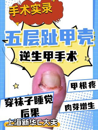 趾甲竟然有5层?误诊50%的"逆生甲"真相! 你听过“逆生甲”吗?很多人误以为是甲沟炎,其实它是与长期穿袜子睡觉有关的特殊疾病,误诊率竟高达50%。在这个手术实录中,一层层剥离患者如贝壳般堆积的趾甲结构,揭示了令人震惊的五层指甲真相。看完你一定会对自己的脚趾刮目相看!#甲沟炎 #儿童甲沟炎 #逆生甲 #嵌甲