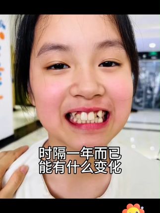 时隔一年而已,能有什么变化 这个钙片一定要安排上,这个小葵花钙铁锌成长片一定要吃#小葵花 #钙铁锌 #成长