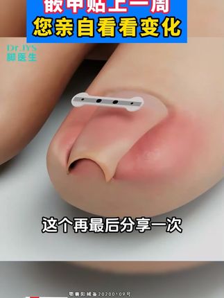 嵌甲就用正甲贴,在家处理不花冤枉钱#嵌甲#甲沟炎#国货