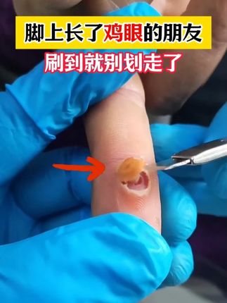 别再忍痛挖鸡眼了!一招在家就能改善鸡眼 #专业修脚 #手足护理 #鸡眼去除小妙招 #鸡眼机 zrl
