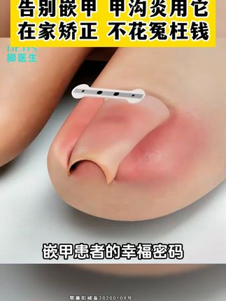 指甲扎肉是嵌甲,一个方法在家处理#甲沟炎#嵌甲#甲沟炎红肿疼怎么处理