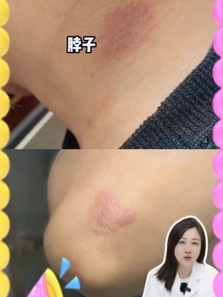 #神经性皮炎长什么样子 #皮肤护理 #无限回购的宝藏单品 #中老年 #养生