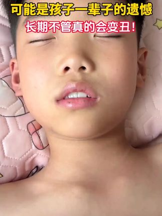 #张嘴呼吸会变丑 #闭嘴贴
