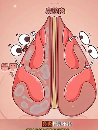 如果你也有鼻炎,打喷嚏流鼻涕的,可以试试#仁和海水喷雾来喷鼻 #鼻炎 #流鼻涕 #打喷嚏 #好物推荐🔥 #种草