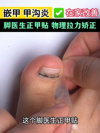 指甲扎肉是嵌甲,一个方法在家处理#甲沟炎#嵌甲#甲沟炎红肿疼怎么处理
