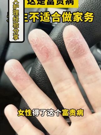 #手部急救黑科技  #草本舒缓天花板  #鹅掌风是什么原因引起的  #鹅掌风的症状 #手脱皮小妙招