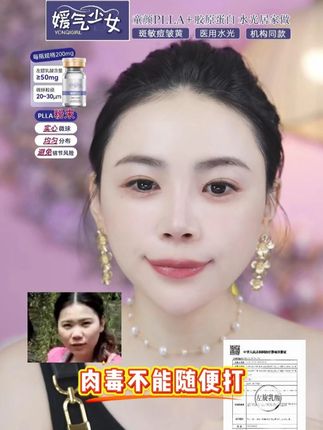 肉毒不能随便打 #媛气少女YONQIGIRL #媛气少女童颜PLLA #媛气少女胶原蛋白 #媛气少女居家水光 #三型胶原蛋白