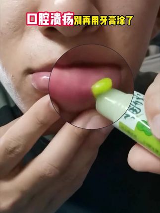 口腔溃疡特别痛,可别再当狠人了!试试仁和口腔修复液 #口腔溃疡 #口腔溃疡怎么办