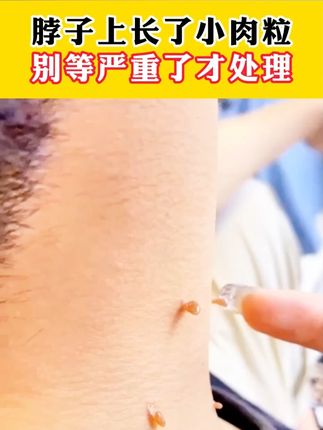 被疣体困扰的 一定要试试这个 #hpv 被疣体困扰的 一定要试试这个#丝状疣 #丝状疣祛除 #脖子上的小肉粒 #疣