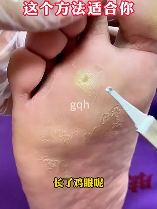 鸡眼别乱挖,这个方法适合你,千万别错过 #鸡眼 #鸡眼跖疣 #鸡眼去除小妙招 #鸡眼机 #鸡眼机 #老茧