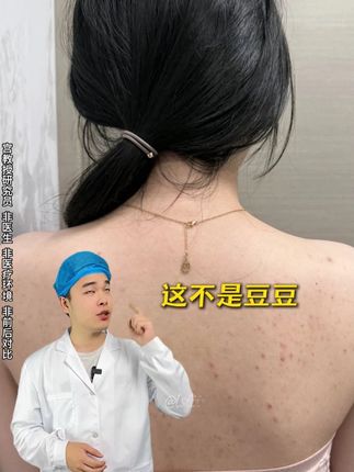 后背疙疙瘩瘩却又想穿小吊带! 是#宫教授身体抛光水 给我勇气!!#祛痘 #夏天该有的样子 #好皮肤养出来