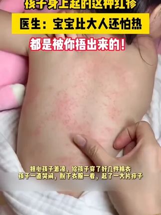 # 国货育儿宝藏#热疹护理黑科技#宝宝痱子护理#一秒降温救星#婴童护理天花板#肌肤安抚大师