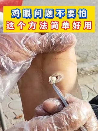 父母十几年的老鸡眼 居然可以这样处理 #专业修脚 #消除脚茧的小妙招 #鸡眼去除小妙招 zrl