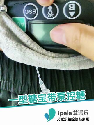 一型糖宝带泵控糖,省心方便#糖尿病 #血糖 #艾派乐胰岛素泵 #一型糖 #二型糖