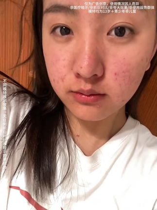 脸上爱长痘的,赶紧试试这个#百草妈咪 的#祛痘小绿瓶 !#祛痘修护精华液 #痘肌必备 #YY