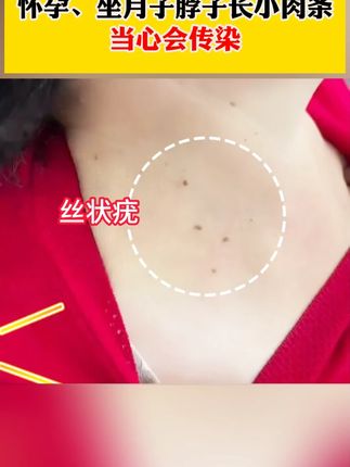 家里怀孕的小心长小肉粒。会传染 #疣 #疣体#丝状疣 #丝状疣祛除 #寻常疣 #hpv