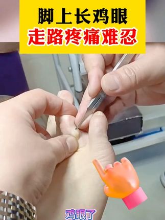 脚上长了鸡眼,疼痛难忍,幸好用了它! #鸡眼 脚上长了鸡眼,疼痛难忍,幸好用了它!#鸡眼去除小妙招 #鸡眼跖疣 #草本 #中老年
